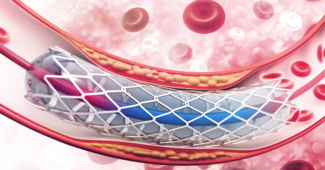 Cardiac Intervention