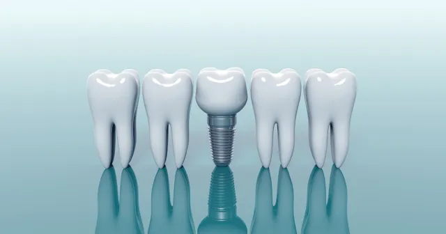 Dental Implant
