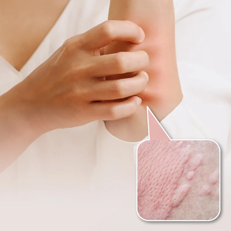 Chronic Urticaria diagnosis package
